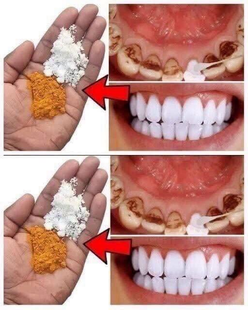 The "2-Minute Tartar Removal" Hack: Dentist-Approved Truth vs. Viral Myth 789844837_1379802330796475_6789154359720523769_n