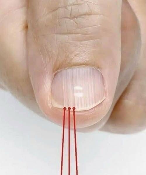 If You Have These Lines on Your Nails After 40, It Is a Clear Sign That... 848517397_2458634377998136_426480073614043257_n