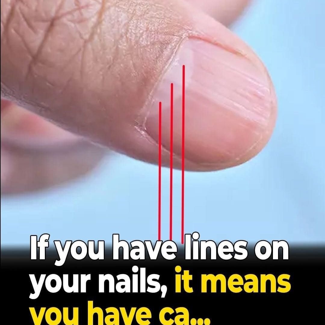 Understanding Vertical Lines on Your Nails: Causes and Health Facts 857119714_10175820111245394_7213543391667706722_n
