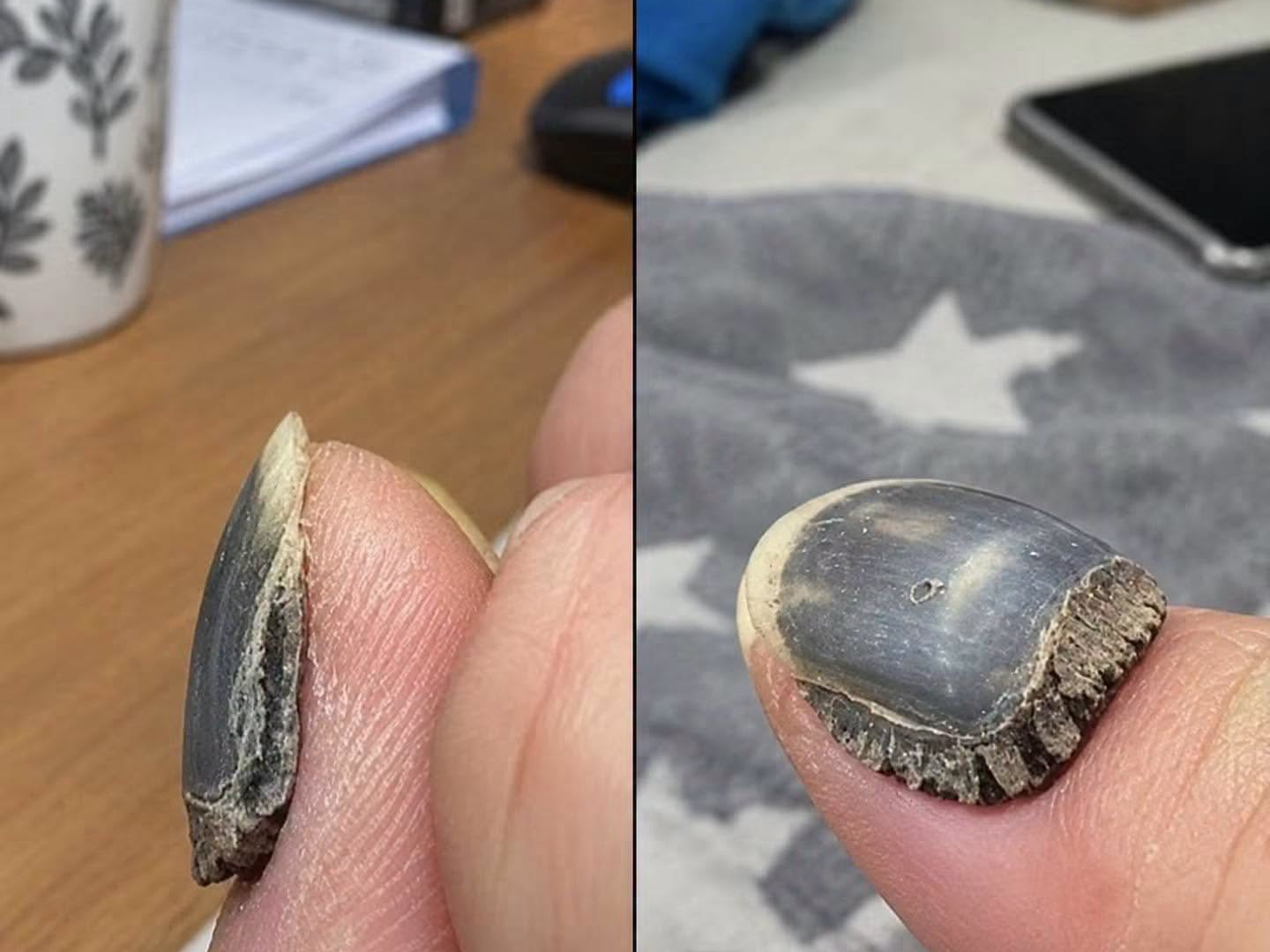 What Is This Dark, Detached Nail? A Closer Look at Onycholysis and What It Means image